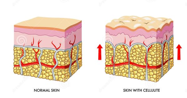 skin-with-without-cellulite